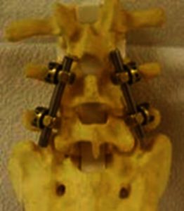 Close-up van een model met twee wervels en metalen staven en schroeven, ter illustratie van wervelkolomfixatie bij een fractuur.