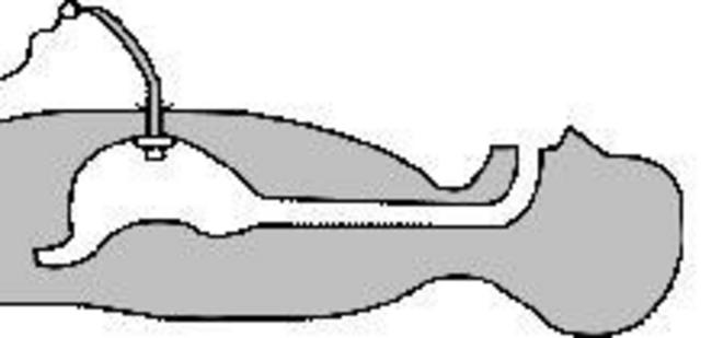 PEG sonde.JPG
