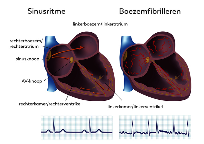 Diagram met twee harten: links Sinusritme met normale stroming, rechts Atriumfibrilleren met chaos. ECG: regelmatig vs. onregelmatig.