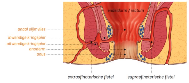 fistel-2.png