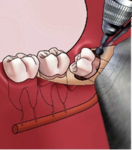 Illustratie van apexresectie: drie kiezen met open tandvlees, een boor bij ontsteking en zichtbare instrumenten en hechtingen.