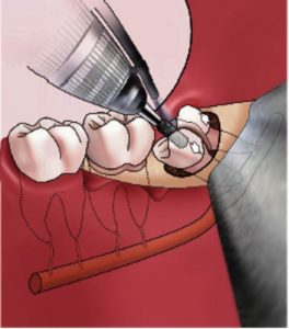 Dentale illustratie van een apexresectie op een kies met boor, omliggende tanden, tandvlees en kaakbeen in doorsnede.