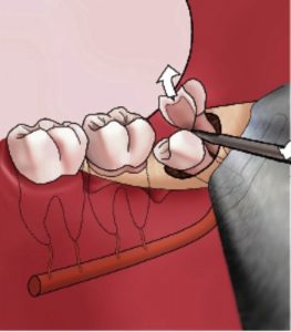 Illustratie van een operatieve verwijdering van een onderste kies met extractietools; omringende tanden, tandvlees en bloedvat zichtbaar.