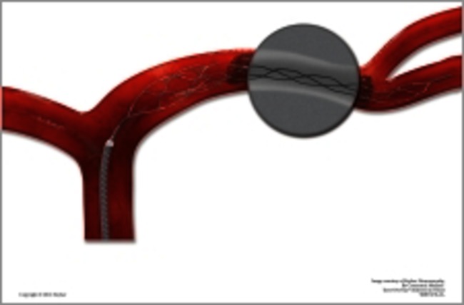 trombectomie-1.png