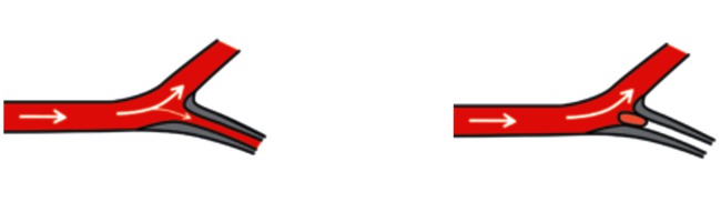 trombectomie-2.PNG