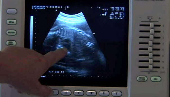 Hand wijst naar een zwart-wit echo op een medisch scherm, met knoppen en meten zichtbaar. Geschikt voor voorlichting gynaecologie.