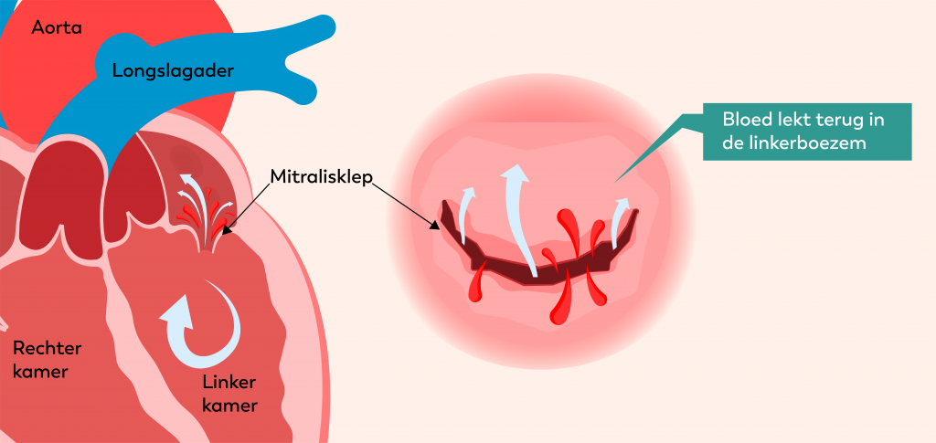Diagram van het hart met lekkende mitralisklep; pijlen tonen bloedterugstroom. Tekst: "Bloed lekt terug in de linkerboezem.