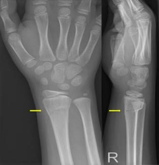 Röntgenfoto's van een rechterpols en hand uit twee hoeken, met gele lijnen en de letter R ter aanduiding van rechts.