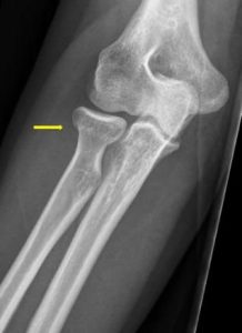 Röntgenfoto van een elleboog met humerus, radius en ulna. Gele pijl wijst naar vermoedelijke fractuur van de radiuskop.