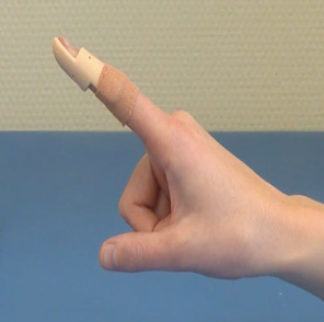 Een hand met gestrekte wijsvinger met malletvinger, voorzien van een beige spalk en verband. Achtergrond verloopt blauw-beige.