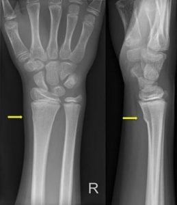 Röntgenfoto's van rechterpols en onderarm vanuit twee hoeken. Gele pijlen tonen polsfractuur met knik in de verre straal.