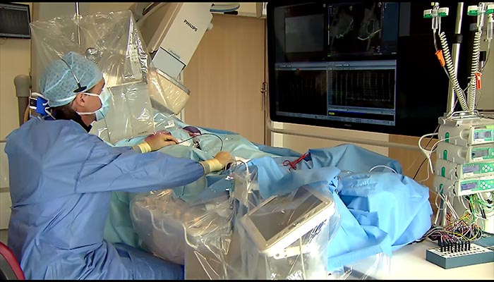 Medisch personeel bedient apparatuur naast patiënt onder blauwe doeken tijdens hartritmestoornissen-ablatie en kijkt naar scherm.