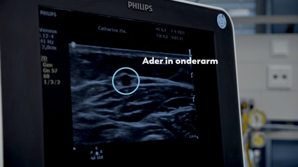 Echoapparaat toont een accentuatie van een ader in de onderarm, met technische gegevens zichtbaar op het Philips scherm.