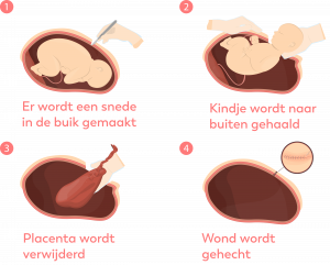 Illustratie van een keizersnede: insnijding buik, baby eruit, placenta eruit, wond wordt gehecht. Met Nederlandse tekst.