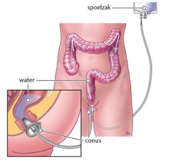 Medische illustratie van colonspoeling bij LAR-syndroom via rectale sonde; inzet toont de conus.