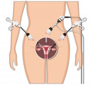 Schema van vrouwentorso met drie laparoscopische instrumenten in buik bij baarmoeder en eierstokken.