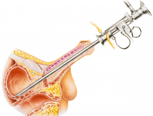Medische illustratie: doorsnede mannelijk bekken met instrument via urinebuis in blaas, toont urologische ingreep.