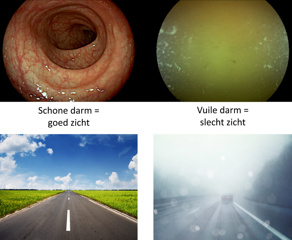 Schone darm bij coloscopie geeft goed zicht; vuile darm, zoals bij rectumstomp, zorgt voor slecht zicht.
