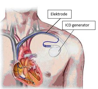 Medische illustratie van een ICD in de borst, met gelabelde generator en elektrode die het hart raakt.