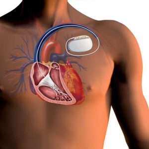 Illustratie van een romp met doorsnede van het hart, pacemaker of ICD en draden onder de huid bij de linkerschouder.