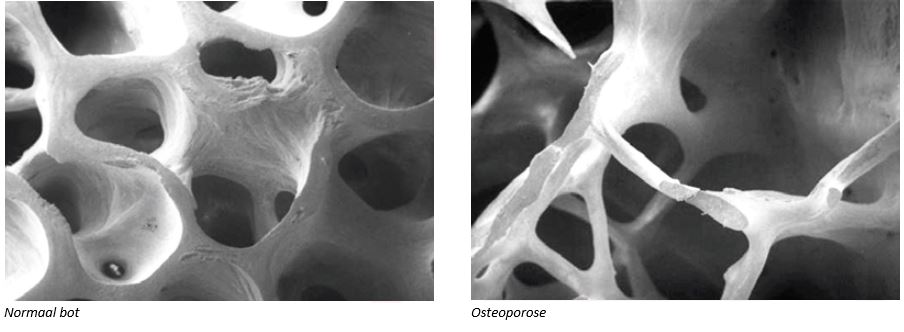 Zwart-witte beelden tonen links gezond, dicht bot en rechts osteoporotisch bot met dunnere, poreuze structuur.