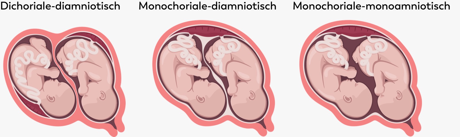 Drie diagrammen tonen typen meerlingen: gescheiden, gedeelde placenta, en gedeelde placenta én vruchtzak, als kaart gerangschikt.