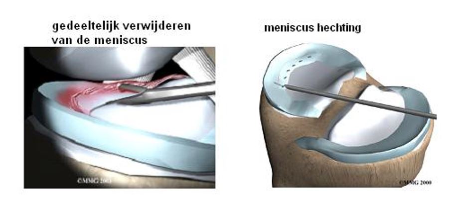 Twee medische illustraties van een kijkoperatie: links gedeeltelijke meniscusverwijdering, rechts meniscushechting.