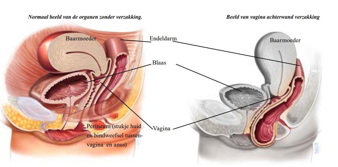 Twee medische zijaanzichten van vrouwelijke bekkenorganen: links normaal, rechts vaginale prolaps, met gelabelde organen.