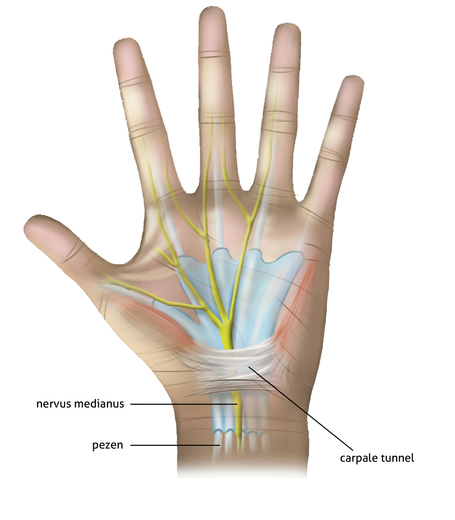 Anatomische tekening van de handpalm met nervus medianus, pezen en carpale tunnel, gelabeld in het Nederlands.