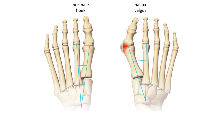 Twee diagrammen tonen voetbotten van boven: links rechte tenen, rechts hallux valgus met scheve grote teen en rood gewricht.