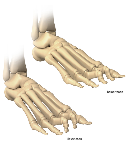 Twee anatomische tekeningen van voeten met zichtbare botten: links klauwtenen, rechts hamertenen, beide gelabeld in het Nederlands.