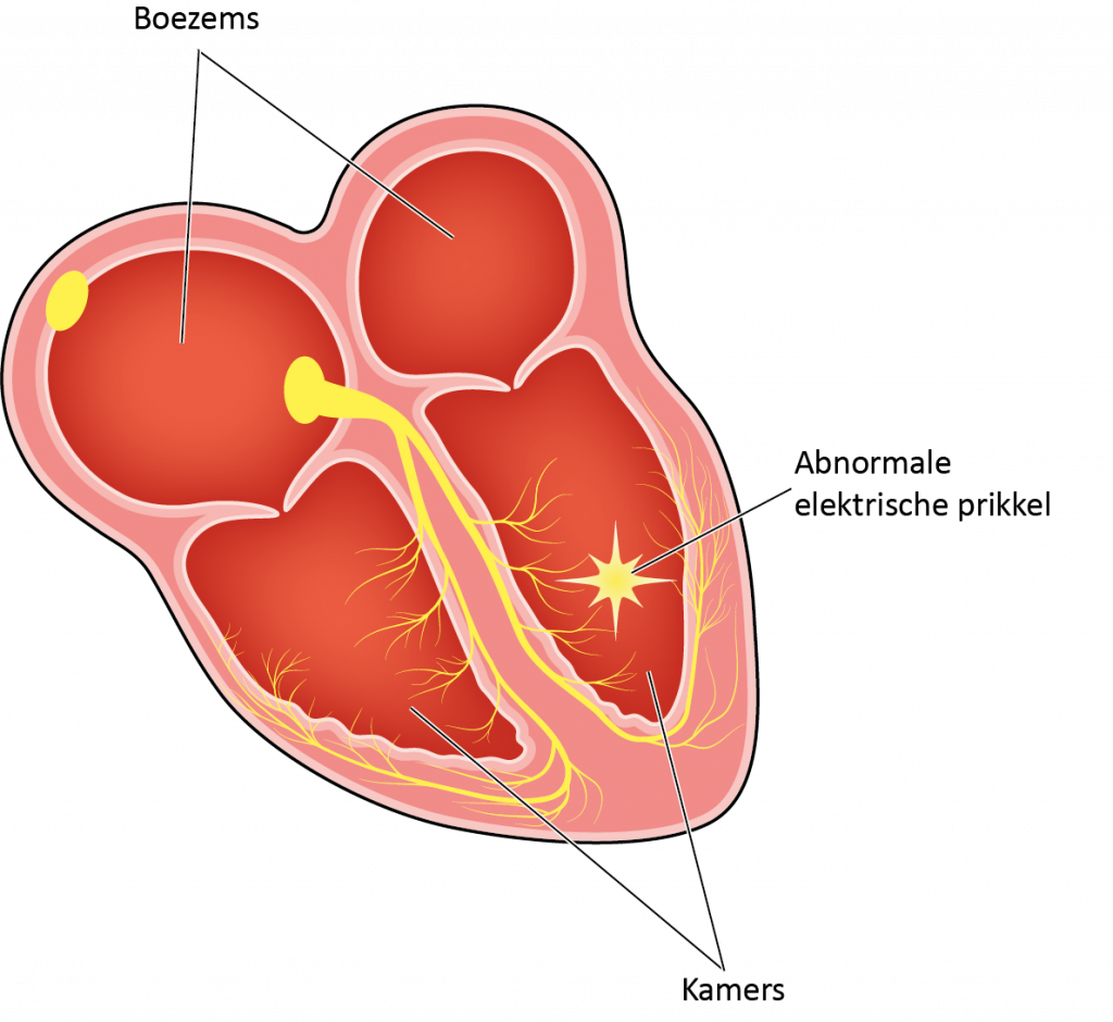 Diagram van een menselijk hart met boezems, kamers en gemarkeerd gebied met 'abnormale elektrische prikkel', uit ICD-folder.