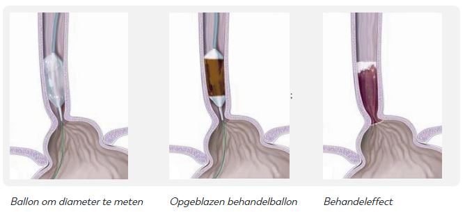 Drie medische afbeeldingen: leeg ballonnetje in slokdarm, opgeblazen behandelballon, slokdarm na behandeling.