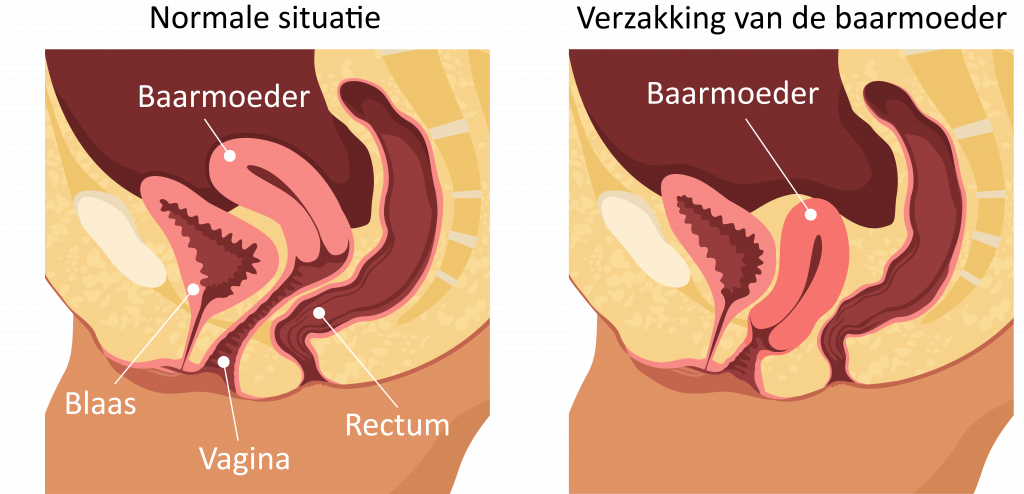 Medische illustratie van een normale en verzakte baarmoeder, met labels voor blaas, vagina, baarmoeder en rectum (Nederlands).