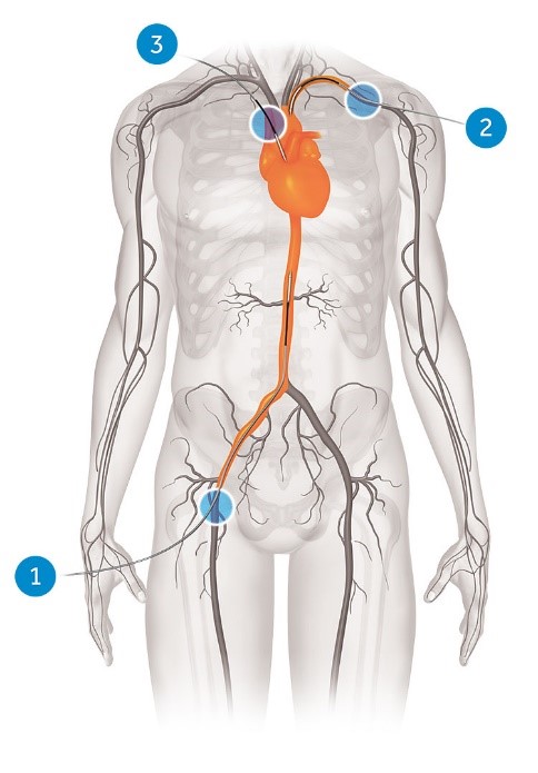 Diagram van menselijk lichaam met oranje slagaders, zwarte aders en drie blauwe markers op arm, borst en dij.