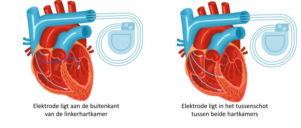 Twee medische diagrammen van een hart met ICD-draden: links buitenlinkerkamer, rechts in het septum. Nederlandse tekst aanwezig.