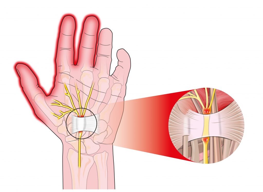 Diagram van een hand met zenuwen in de pols, rode vingers tonen pijn. Inzet vergroot beknelde zenuw bij carpaletunnelsyndroom.