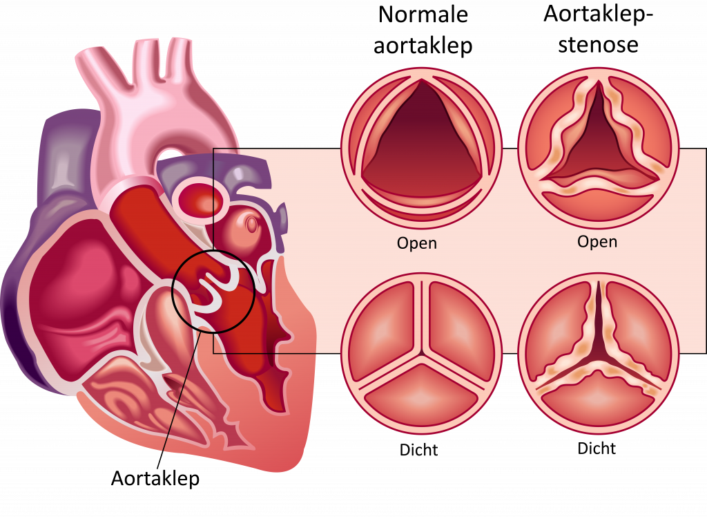 Diagram van het hart met gemarkeerde aortaklep; rechts normale vs. vernauwde klep, open en gesloten.