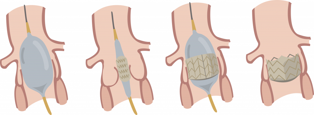 Illustratie van vier stappen: ballon inbrengen, stent plaatsen, ballon opblazen, ballon verwijderen.