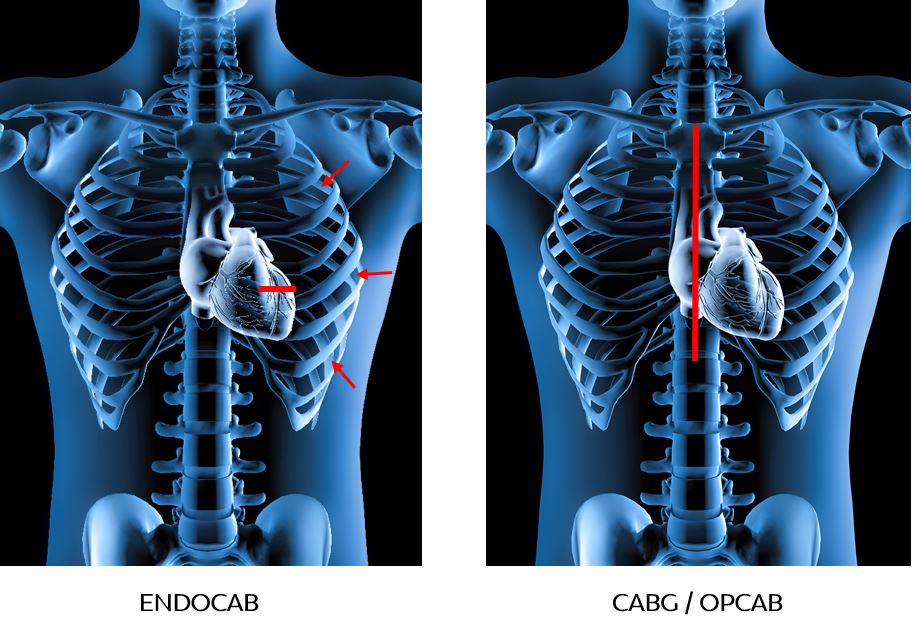 Twee medische illustraties van een borstkas: links rode pijlen bij het hart (ENDO-CAB), rechts een rode lijn op de borst (CABG/OPCAB).