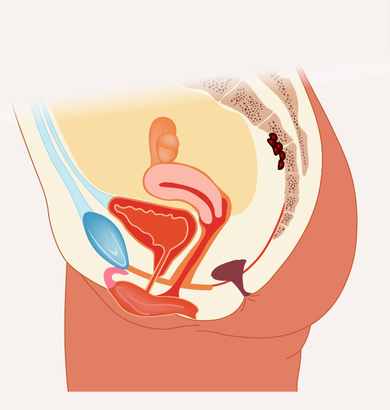 Medische illustratie zijaanzicht vrouwelijk bekken met endometriosehaarden op darmwand, relevant voor IORT bij endeldarmkanker.