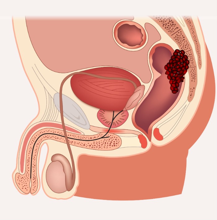 Medische illustratie van het mannelijk bekken met blaas, prostaat, endeldarm en tumor; behandeling met IORT voorgesteld.
