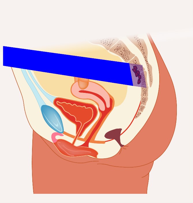 Medische illustratie van sagittale doorsnede vrouwelijk bekken; blaasje, baarmoeder, vagina, endeldarm; dikke darm deels afgedekt.