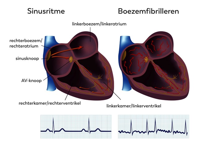 Twee doorsneden van het hart tonen normaal ritme en boezemfibrilleren voor en na PV-isolatie, met labels en ECG's.