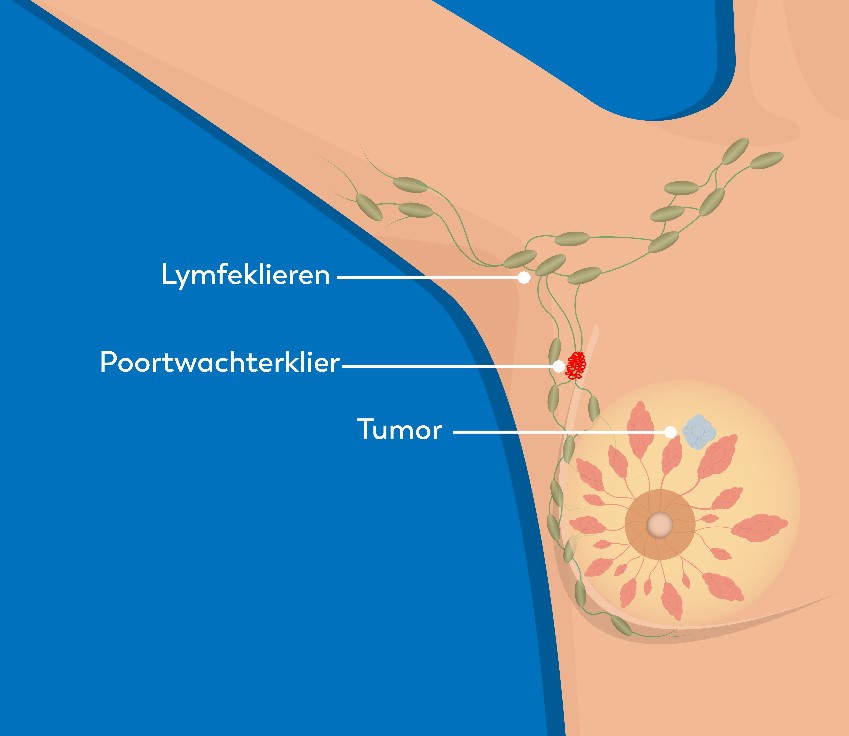 Medische illustratie van een borst met tumor, poortwachtersklier en oksellymfeklieren voor uitleg bij borstkankeronderzoek.