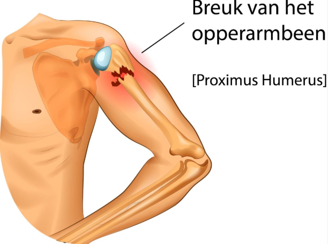 Diagram van een bovenarm met een breuk in de proximale humerus nabij het schoudergewricht, gelabeld als "Breuk van het opperarmbeen".