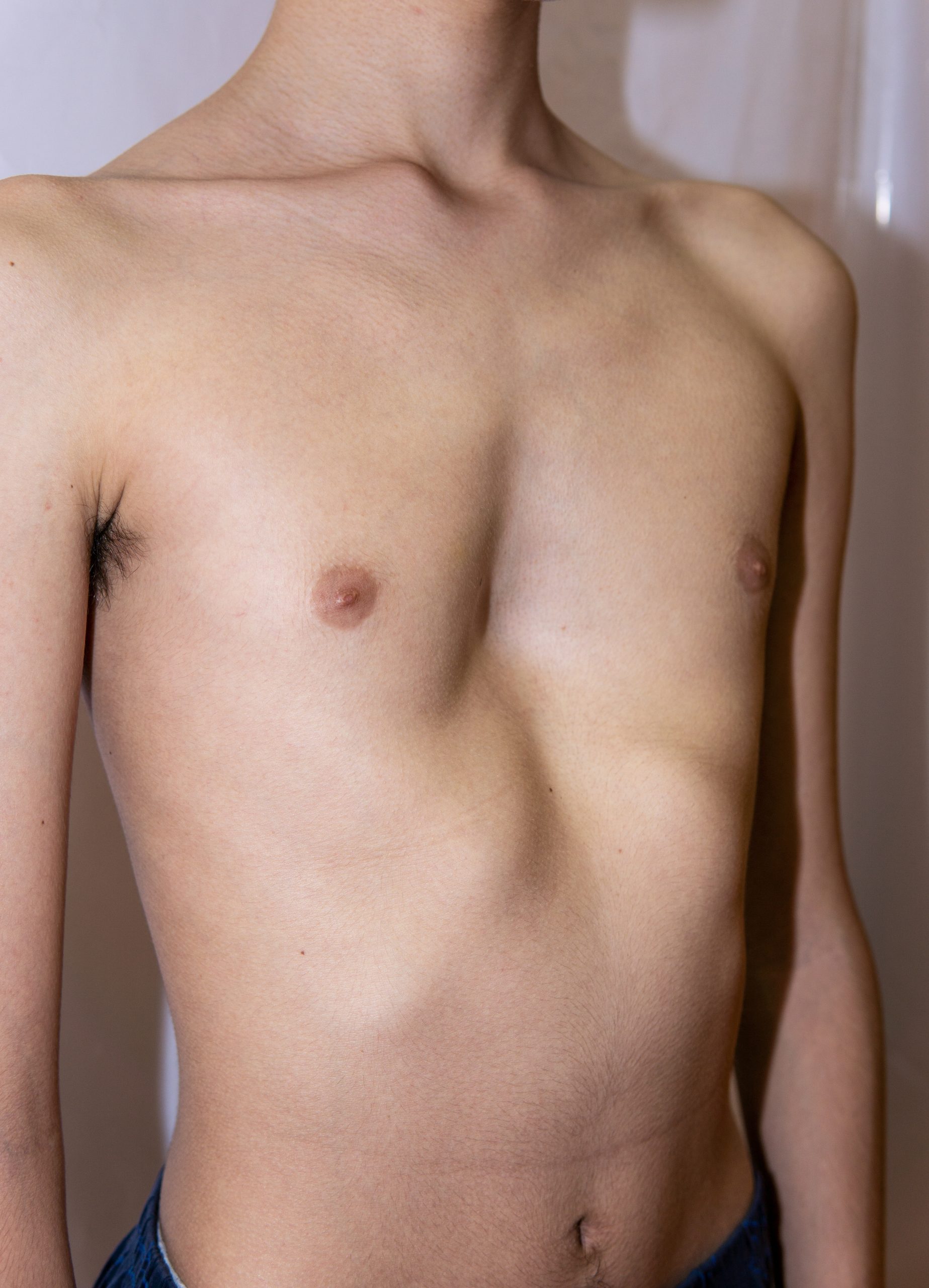 Persoon met kort haar en ontbloot bovenlijf, zichtbaar van schouders tot taille, met een kuil in de borst (pectus excavatum).