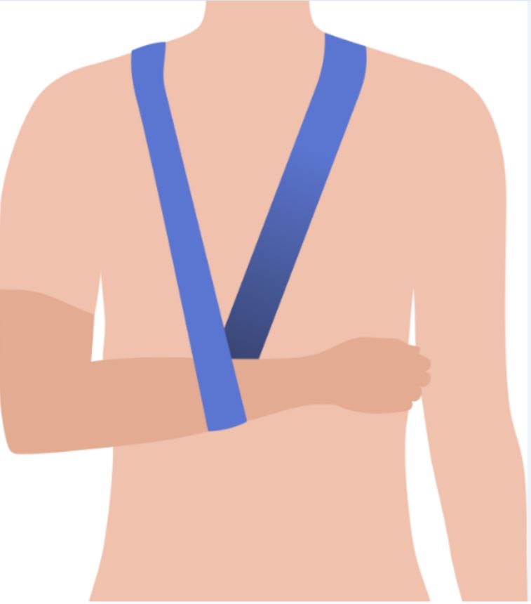 Illustratie van persoon met blauwe mitella, linkerarm gesteund over de borst na bovenarmbreuk, band over rechterschouder.