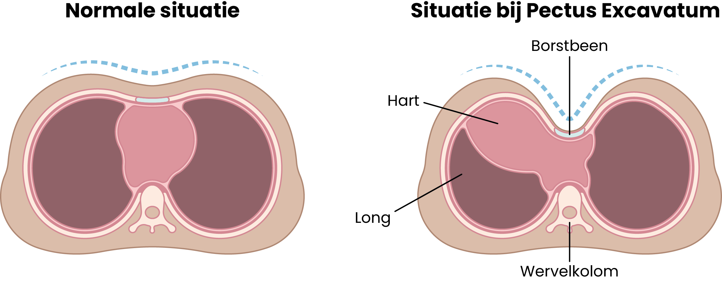 Twee doorsneden tonen een normale borstkas en een met pectus excavatum, met verschil in borstbeen, hart, longen en wervelkolom.