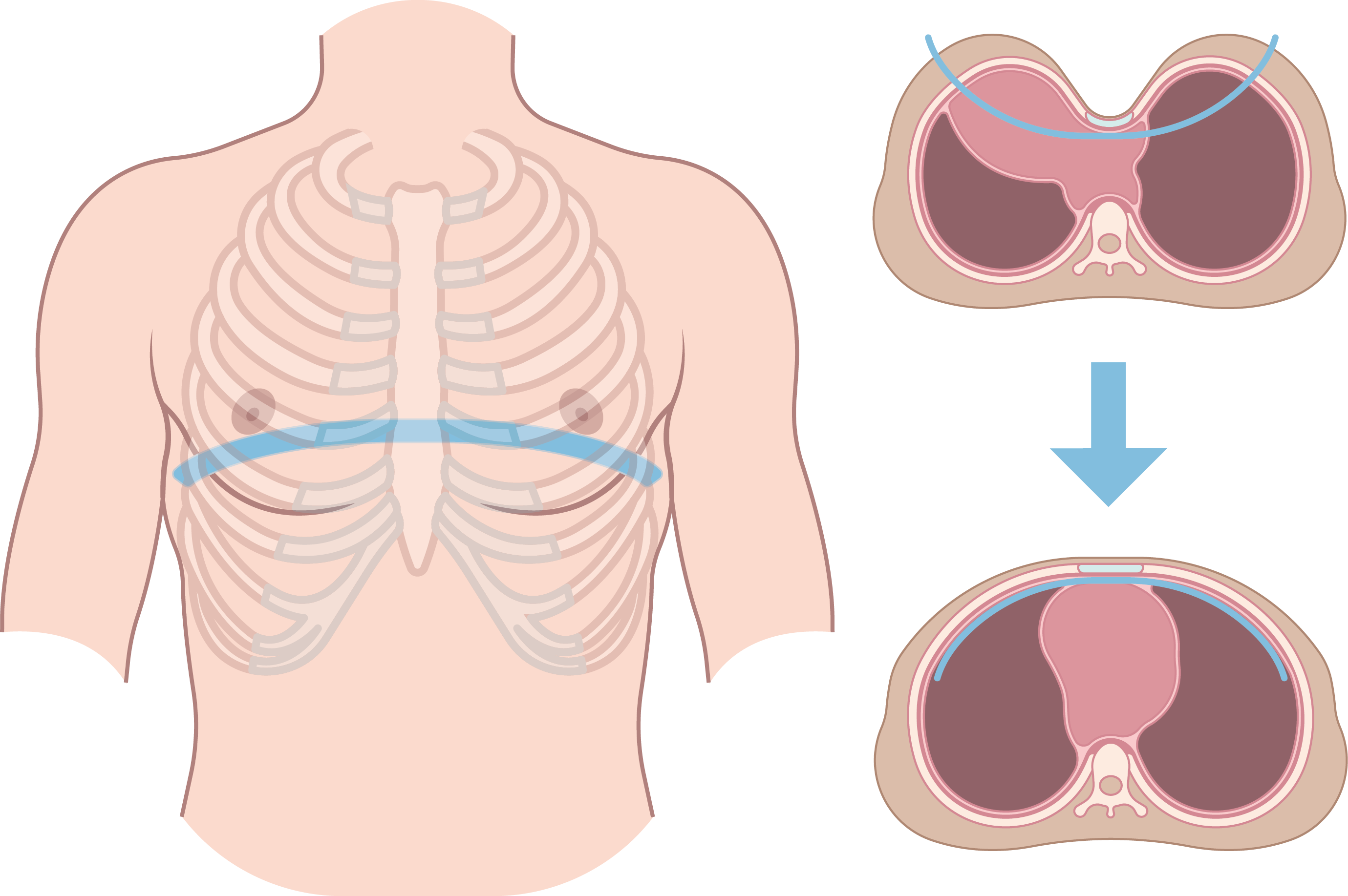 Illustratie van ribbenkast en middenrif, met doorsneden van inademing en hoe pectus excavatum dit proces beïnvloedt.
